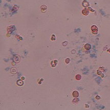 Eritrociti dismorfici