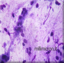 Helicobacter pylori1