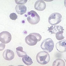thalassemia